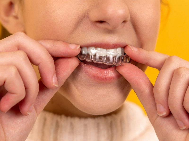 Person fitting a clear aligner over their teeth