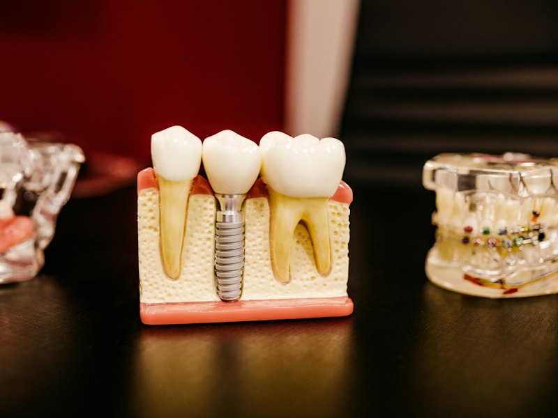 Model of a dental implant supporting a crown between natural teeth