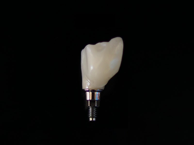 Ceramic crown mounted on a small-diameter implant post